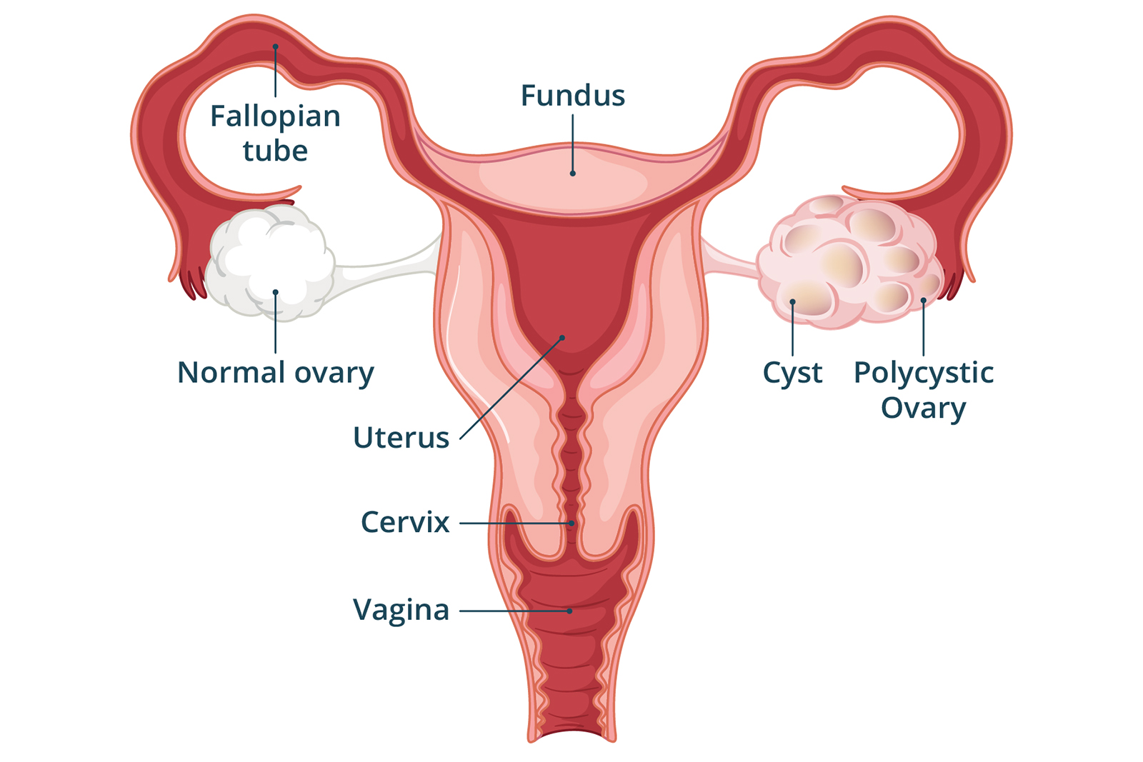 PCOS Diet